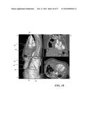 METHOD OF ANALYZING HOLLOW ANATOMICAL STRUCTURES FOR PERCUTANEOUS     IMPLANTATION diagram and image
