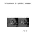 METHOD OF ANALYZING HOLLOW ANATOMICAL STRUCTURES FOR PERCUTANEOUS     IMPLANTATION diagram and image