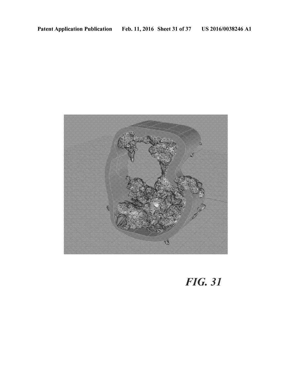 METHOD OF ANALYZING HOLLOW ANATOMICAL STRUCTURES FOR PERCUTANEOUS     IMPLANTATION - diagram, schematic, and image 32