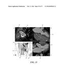 METHOD OF ANALYZING HOLLOW ANATOMICAL STRUCTURES FOR PERCUTANEOUS     IMPLANTATION diagram and image