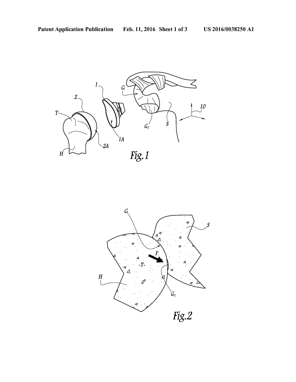 DETERMINING IMPLANTATION CONFIGURATION FOR A PROSTHETIC COMPONENT OR     APPLICATION OF A RESURFACING TOOL - diagram, schematic, and image 02