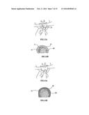 METHODS FOR DISPLACING THE SCHNEIDERIAN MEMBRANE diagram and image