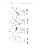 SYSTEM AND METHOD FOR SECURING TISSUE TO BONE diagram and image