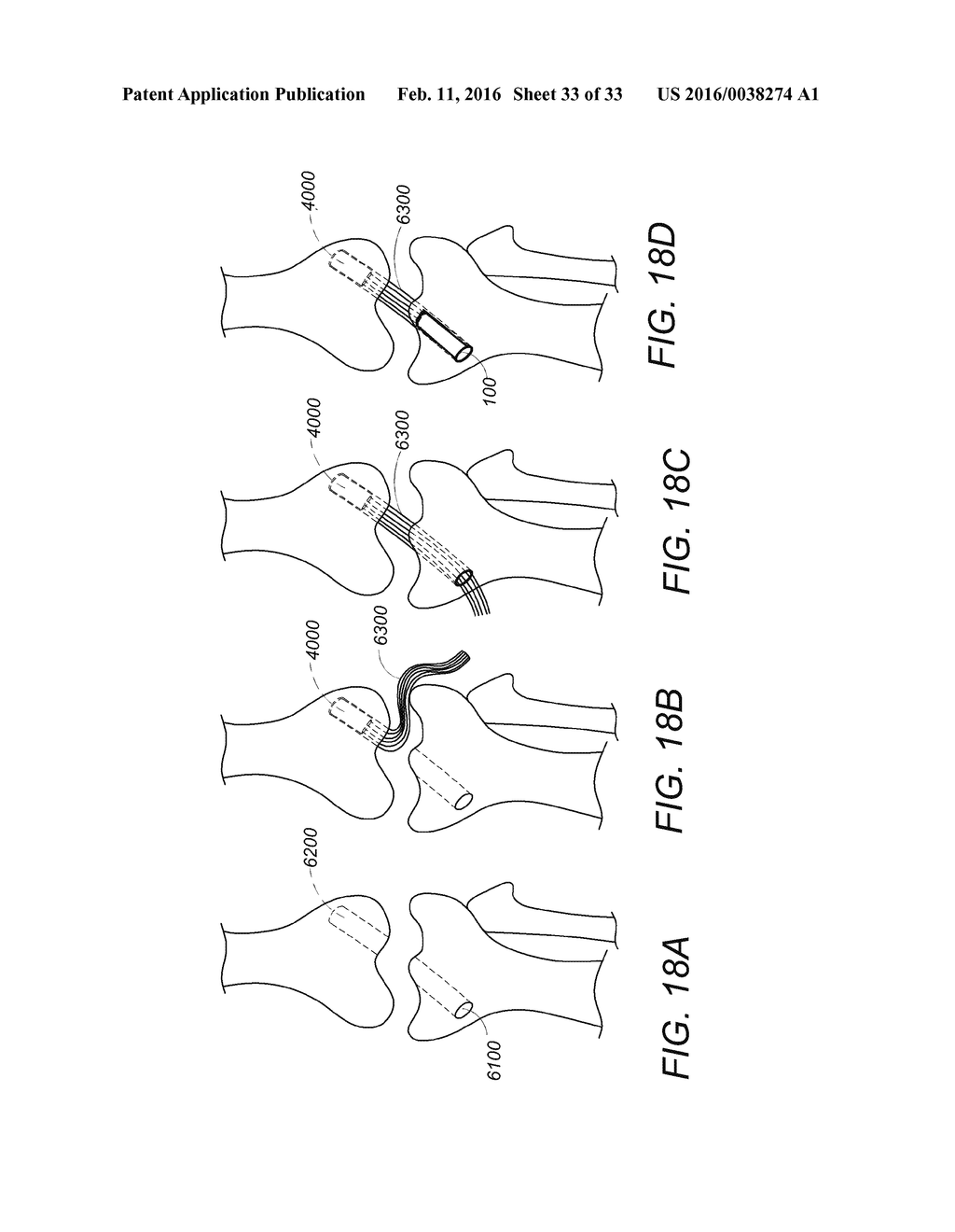 SYSTEM AND METHOD FOR SECURING TISSUE TO BONE - diagram, schematic, and image 34