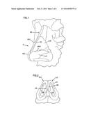 NASAL VALVE TREATMENT METHOD & APPARATUS diagram and image