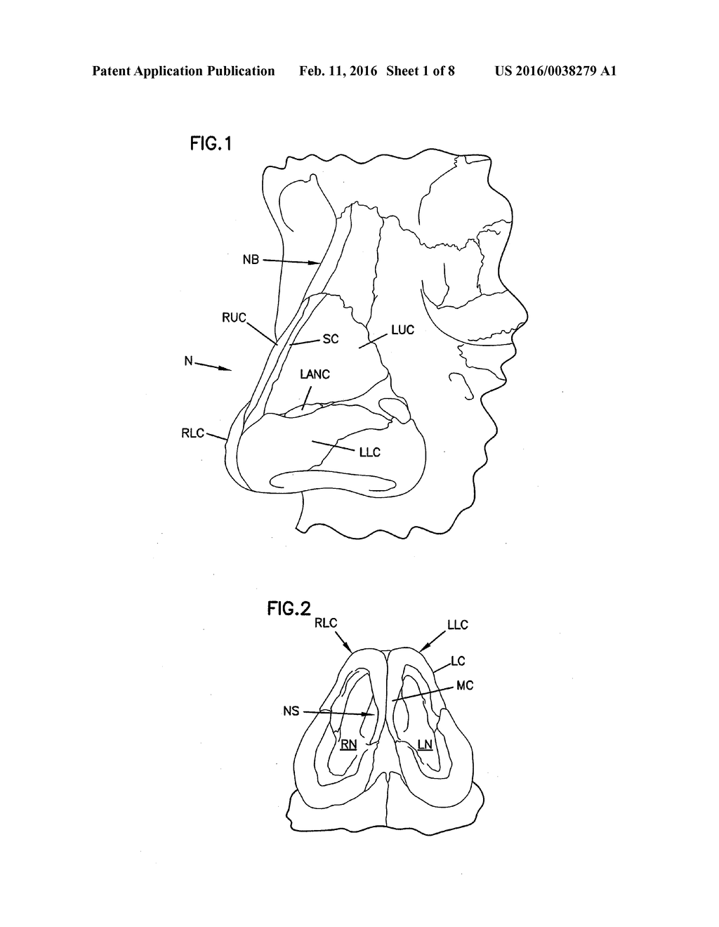 NASAL VALVE TREATMENT METHOD & APPARATUS - diagram, schematic, and image 02