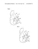 NASAL VALVE TREATMENT METHOD & APPARATUS diagram and image