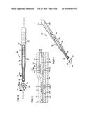 NASAL VALVE TREATMENT METHOD & APPARATUS diagram and image