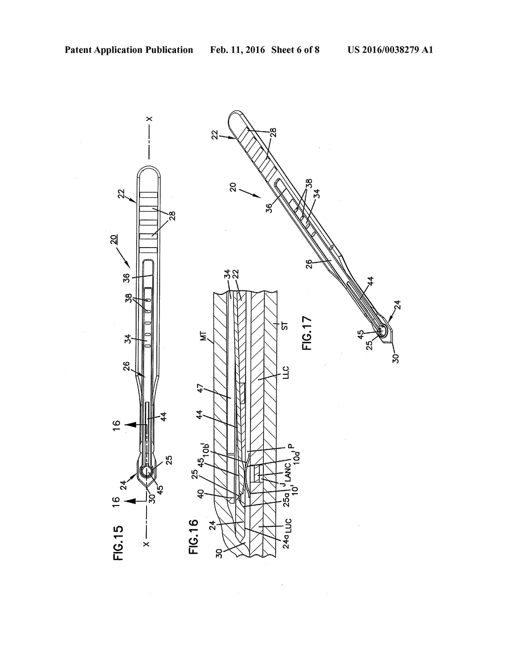 NASAL VALVE TREATMENT METHOD & APPARATUS - diagram, schematic, and image 07