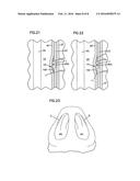 NASAL VALVE TREATMENT METHOD & APPARATUS diagram and image