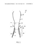 IMPROVEMENTS RELATING TO TRANSCATHETER STENT-VALVES diagram and image