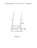 IMPROVEMENTS RELATING TO TRANSCATHETER STENT-VALVES diagram and image