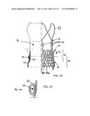 IMPROVEMENTS RELATING TO TRANSCATHETER STENT-VALVES diagram and image