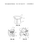 HEART VALVE PROSTHESIS WITH COLLAPSIBLE VALVE AND METHOD OF DELIVERY     THEREOF diagram and image