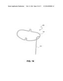 HEART VALVE PROSTHESIS WITH COLLAPSIBLE VALVE AND METHOD OF DELIVERY     THEREOF diagram and image