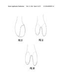 Posterior-Stabilized Knee Implant Components and Instruments diagram and image