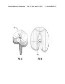 Posterior-Stabilized Knee Implant Components and Instruments diagram and image