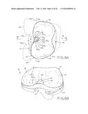 TIBIAL BEARING COMPONENT FOR A KNEE PROSTHESIS WITH IMPROVED ARTICULAR     CHARACTERISTICS diagram and image