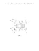 SPINAL IMPLANT SYSTEM AND METHOD diagram and image