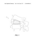 VARIABLE LORDOSIS SPACER AND RELATED METHODS OF USE diagram and image