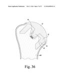 SIZING INSTRUMENT AND PUNCH FOR USE IN A SURGICAL PROCEDURE TO IMPLANT A     STEMLESS HUMERAL COMPONENT diagram and image