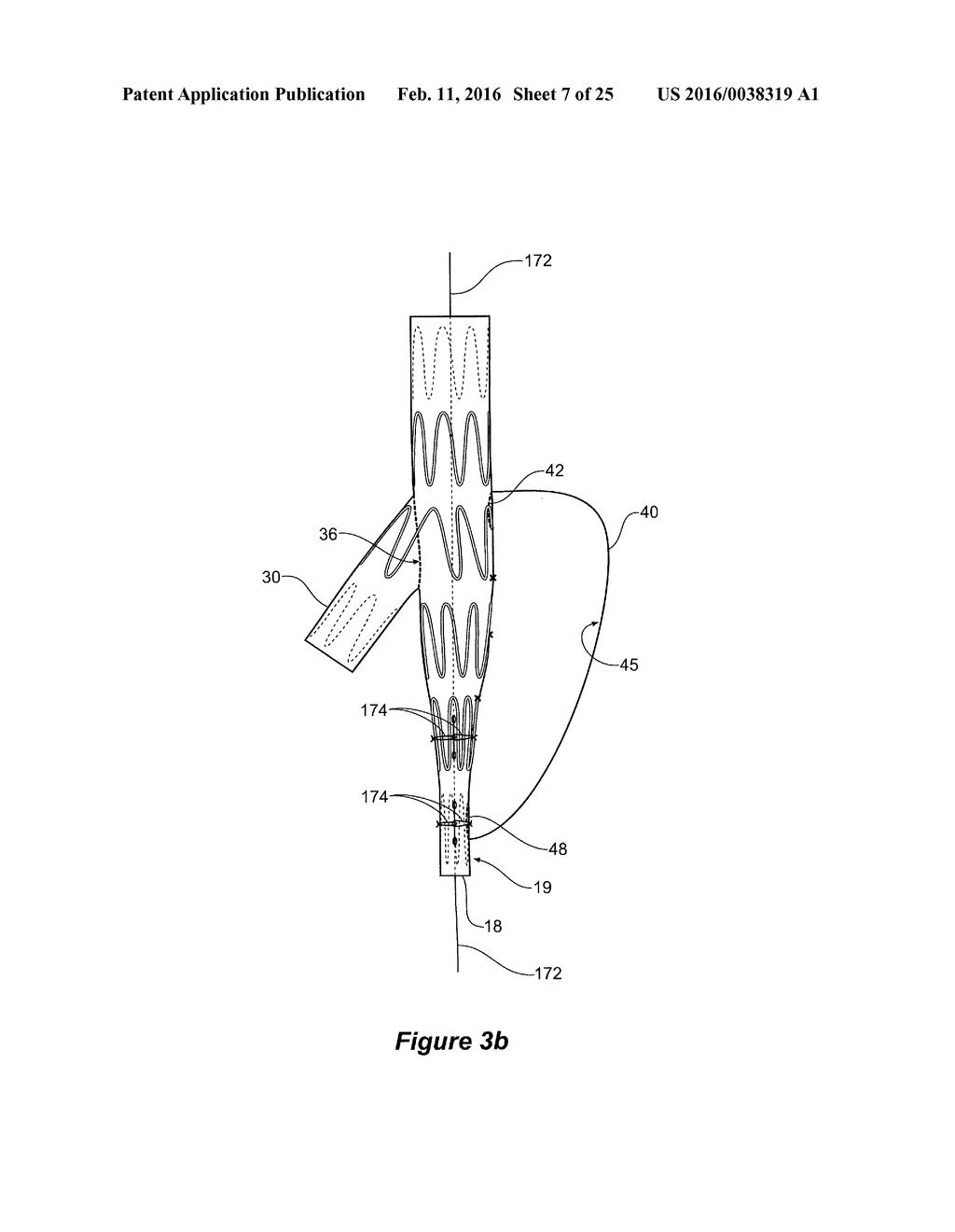 ENDOVASCULAR GRAFT HAVING A CANNULATION POCKET - diagram, schematic, and image 08