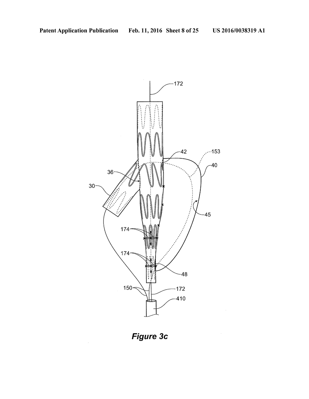 ENDOVASCULAR GRAFT HAVING A CANNULATION POCKET - diagram, schematic, and image 09