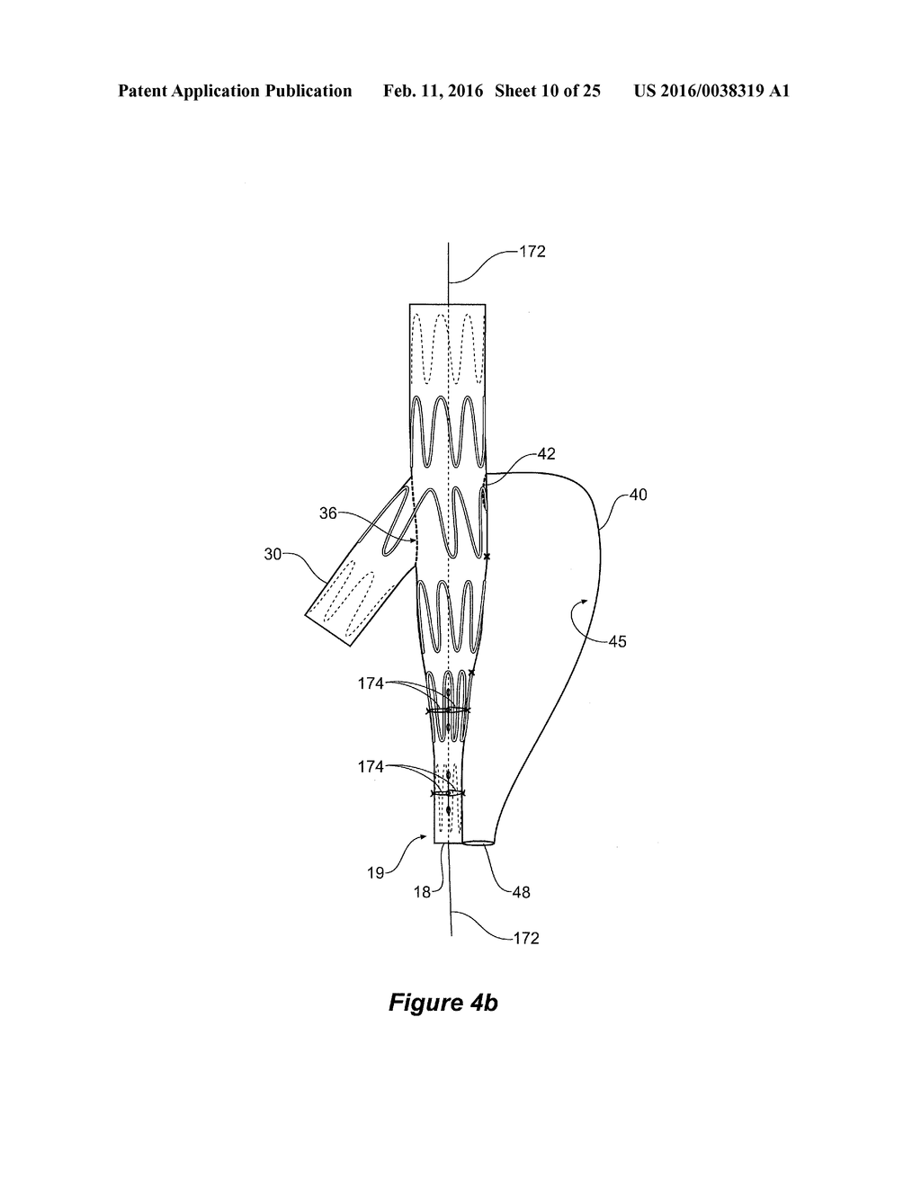 ENDOVASCULAR GRAFT HAVING A CANNULATION POCKET - diagram, schematic, and image 11