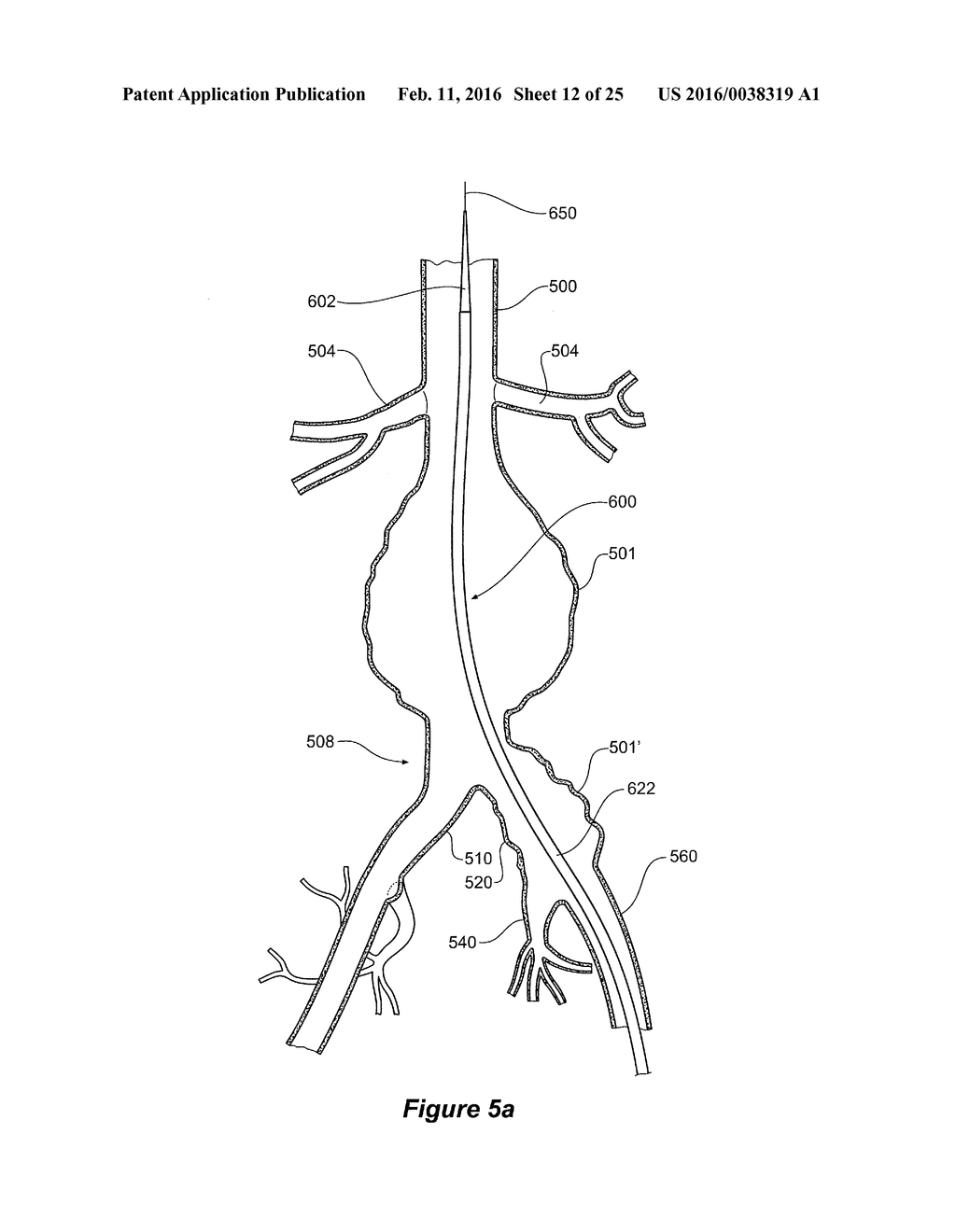 ENDOVASCULAR GRAFT HAVING A CANNULATION POCKET - diagram, schematic, and image 13