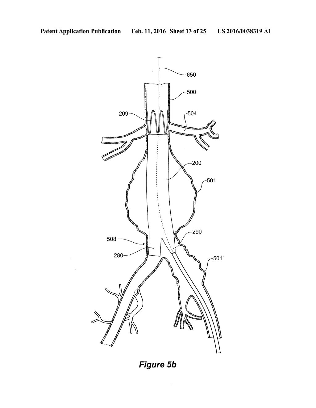 ENDOVASCULAR GRAFT HAVING A CANNULATION POCKET - diagram, schematic, and image 14