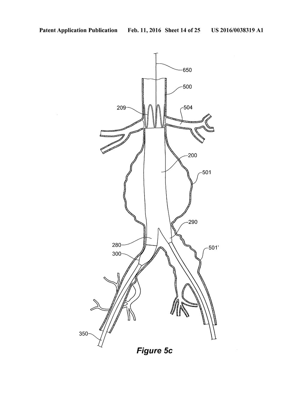 ENDOVASCULAR GRAFT HAVING A CANNULATION POCKET - diagram, schematic, and image 15