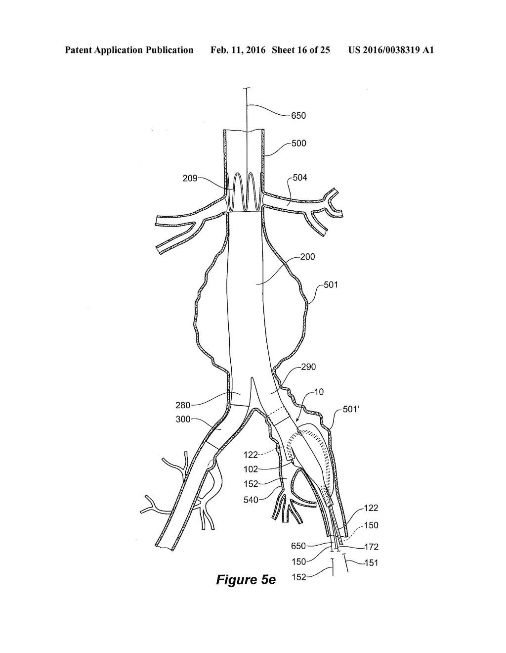 ENDOVASCULAR GRAFT HAVING A CANNULATION POCKET - diagram, schematic, and image 17