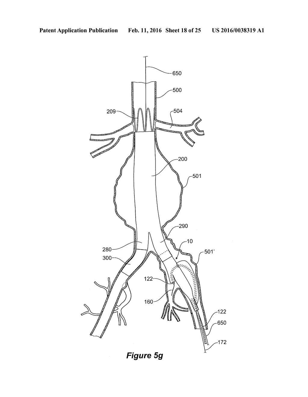 ENDOVASCULAR GRAFT HAVING A CANNULATION POCKET - diagram, schematic, and image 19