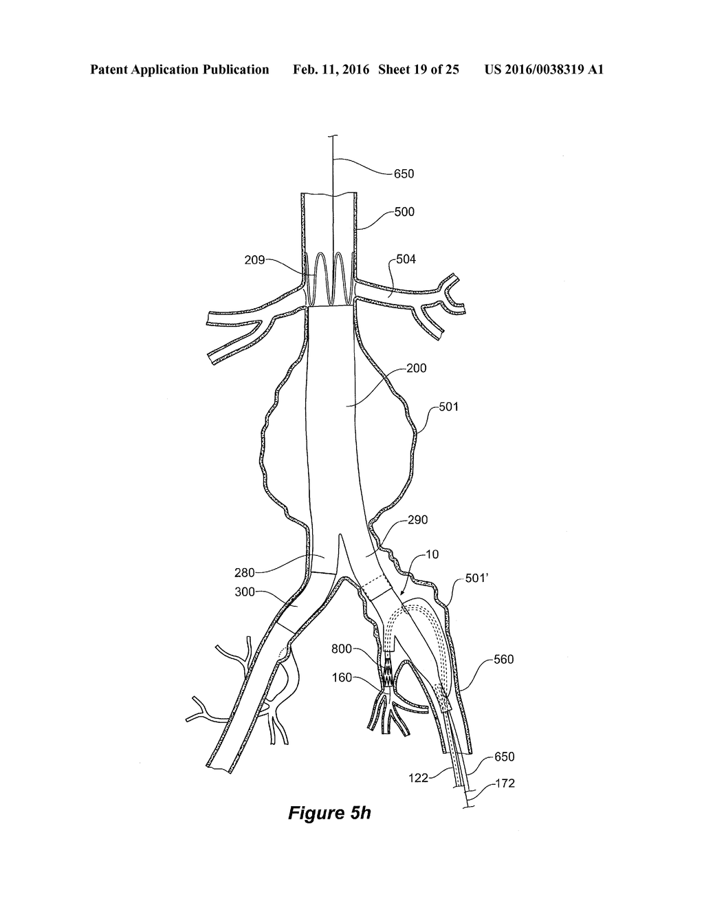 ENDOVASCULAR GRAFT HAVING A CANNULATION POCKET - diagram, schematic, and image 20