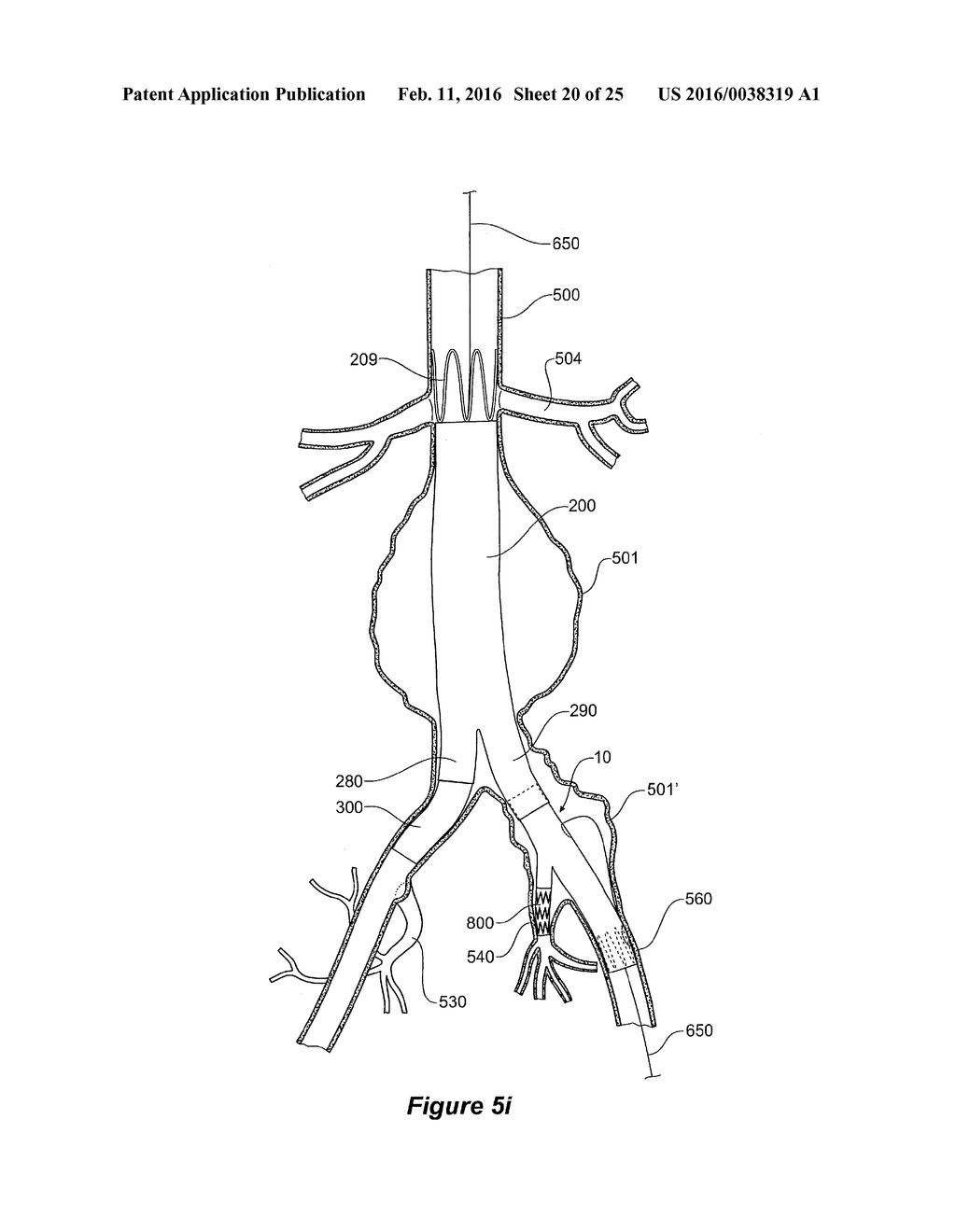 ENDOVASCULAR GRAFT HAVING A CANNULATION POCKET - diagram, schematic, and image 21