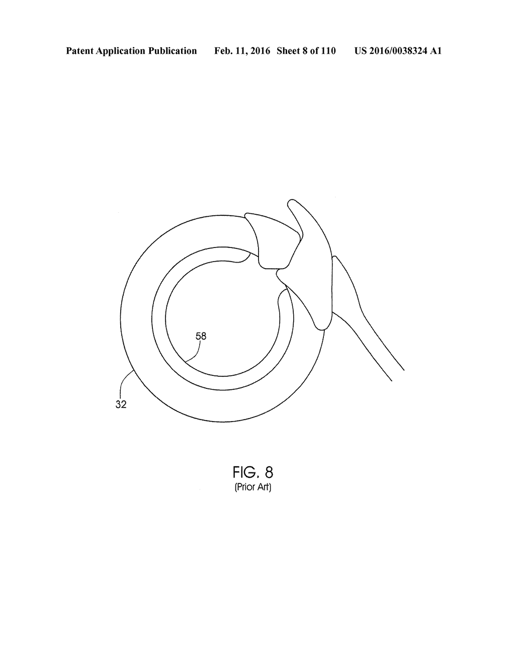 ADJUSTABLE IMPLANT AND METHOD OF USE - diagram, schematic, and image 09