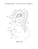 ADJUSTABLE IMPLANT AND METHOD OF USE diagram and image