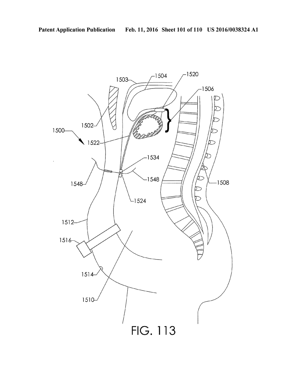 ADJUSTABLE IMPLANT AND METHOD OF USE - diagram, schematic, and image 102