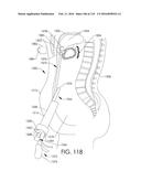 ADJUSTABLE IMPLANT AND METHOD OF USE diagram and image