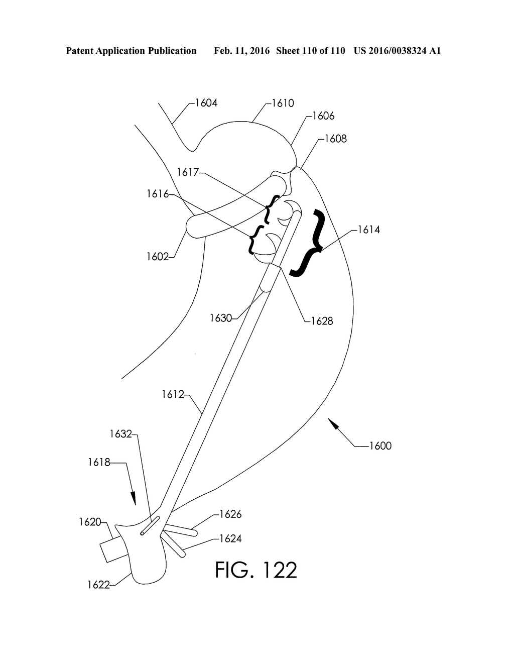 ADJUSTABLE IMPLANT AND METHOD OF USE - diagram, schematic, and image 111