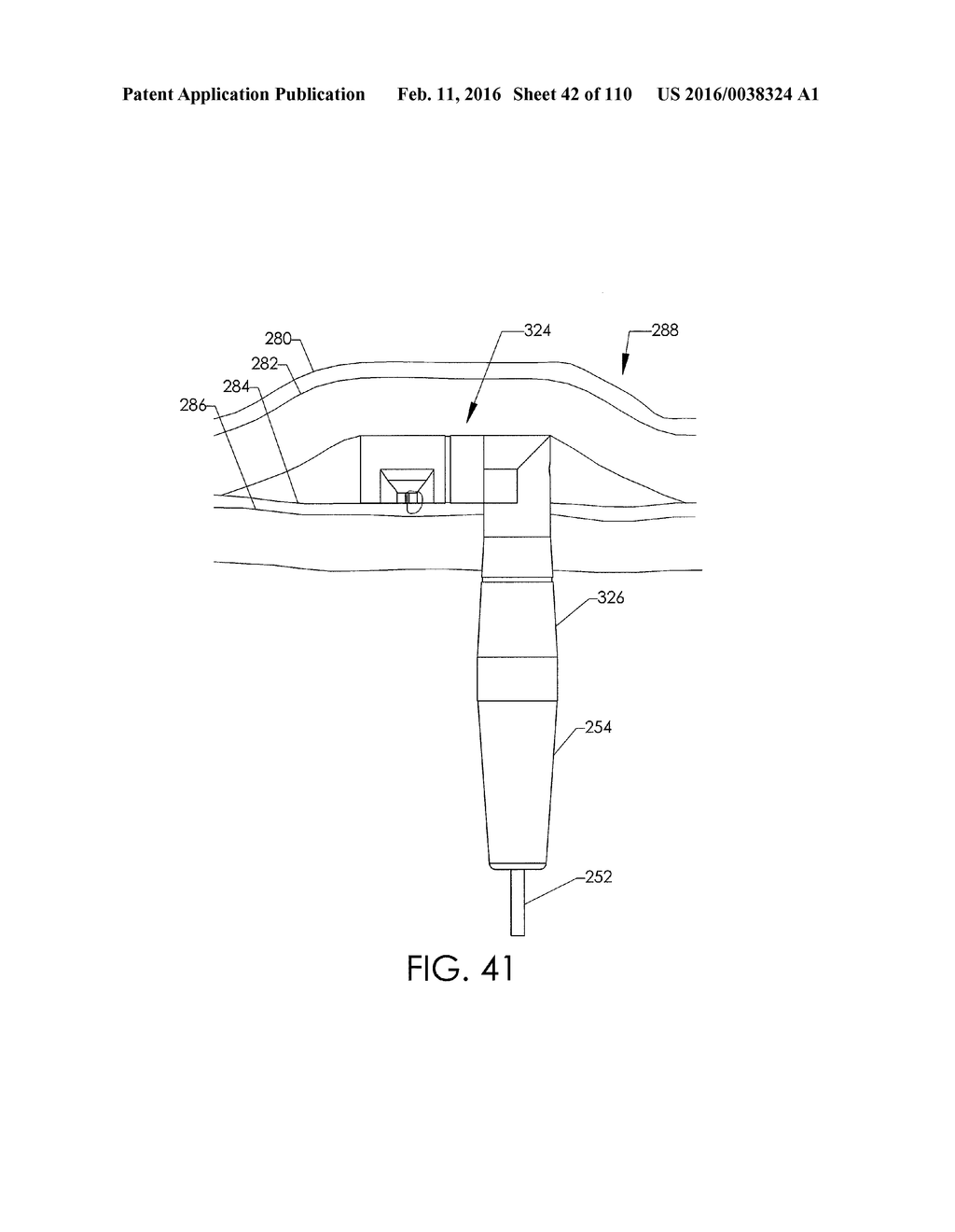 ADJUSTABLE IMPLANT AND METHOD OF USE - diagram, schematic, and image 43