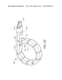 ADJUSTABLE IMPLANT AND METHOD OF USE diagram and image