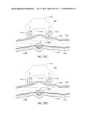 ADJUSTABLE IMPLANT AND METHOD OF USE diagram and image