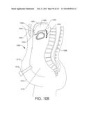 ADJUSTABLE IMPLANT AND METHOD OF USE diagram and image