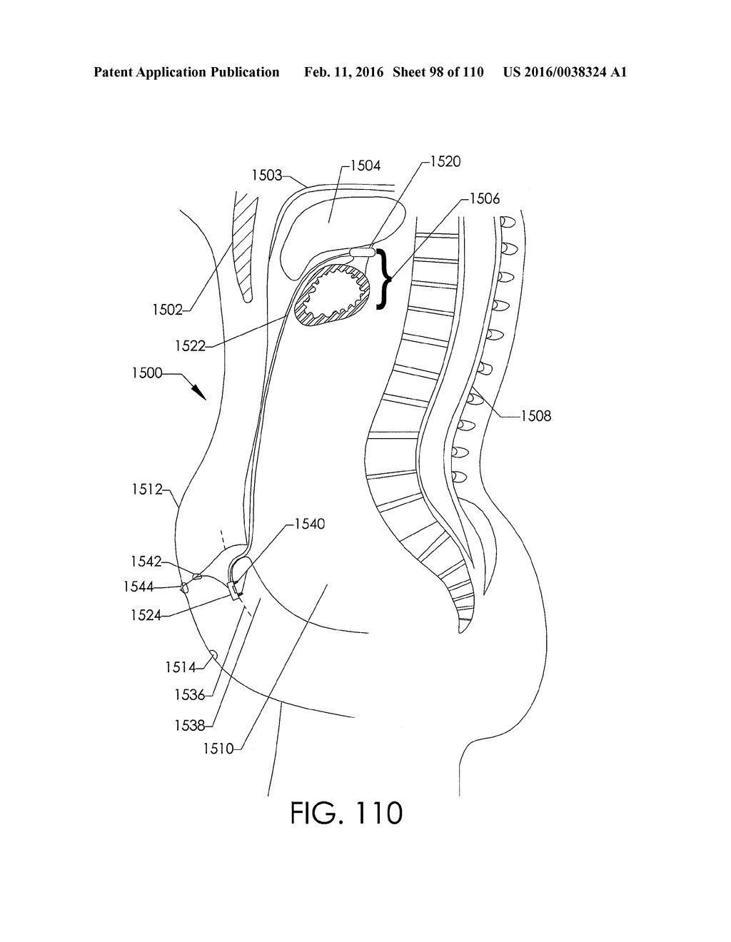 ADJUSTABLE IMPLANT AND METHOD OF USE - diagram, schematic, and image 99