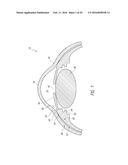 SYSTEMS AND METHODS FOR DELIVERING AN OCULAR IMPLANT TO THE SUPRACHOROIDAL     SPACE WITHIN AN EYE diagram and image