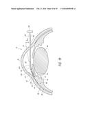 SYSTEMS AND METHODS FOR DELIVERING AN OCULAR IMPLANT TO THE SUPRACHOROIDAL     SPACE WITHIN AN EYE diagram and image