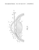 SYSTEMS AND METHODS FOR DELIVERING AN OCULAR IMPLANT TO THE SUPRACHOROIDAL     SPACE WITHIN AN EYE diagram and image