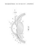 SYSTEMS AND METHODS FOR DELIVERING AN OCULAR IMPLANT TO THE SUPRACHOROIDAL     SPACE WITHIN AN EYE diagram and image