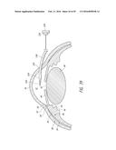 SYSTEMS AND METHODS FOR DELIVERING AN OCULAR IMPLANT TO THE SUPRACHOROIDAL     SPACE WITHIN AN EYE diagram and image